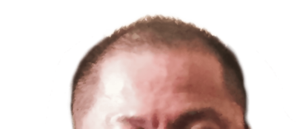 頭皮へ直接投与01 術前の画像