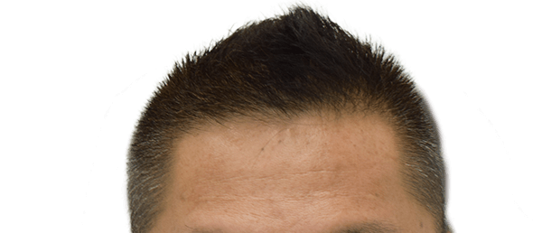 頭皮へ直接投与02 術後の画像