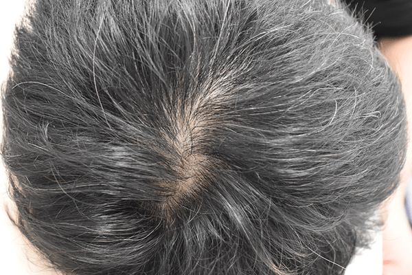 頭皮へ直接投与04 術後の画像